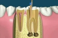 根管治疗后，牙齿寿命有多久?