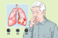 咳痰反反复复，可能是哪些疾病?