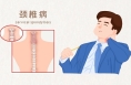 四种类型颈椎病，哪一种最不好惹 | 科普时间