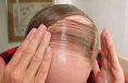 秋季脫發(fā)迎高峰 你的發(fā)際線(xiàn)還好嗎