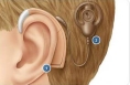 陕西贫困家庭可申请6岁以下聋儿免费植人工耳蜗