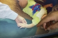 1岁孩子手指被压面机绞断 经治疗终于保住指头