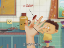 【渭南科普】儿童遭遇烫伤该怎么处理？