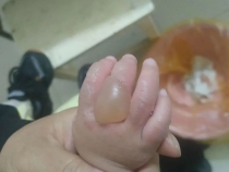 渭南1岁幼童在饺子馆内被烫伤，双方争执不下，治疗费谁来出？